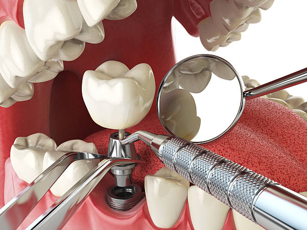 Best Emergency Broken Tooth Repair in Fobes Hill, WA